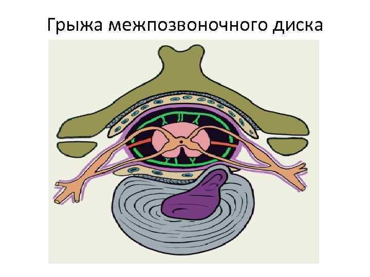 Грыжа межпозвоночного диска 