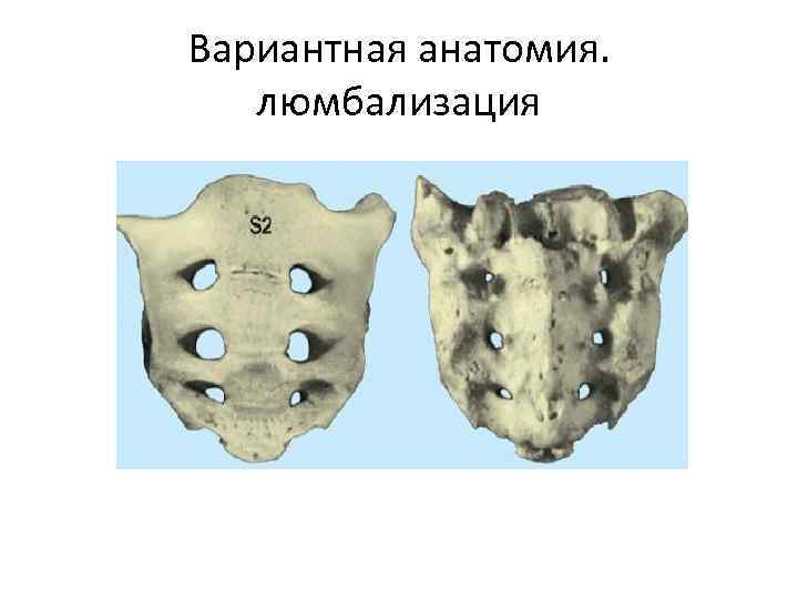 Вариантная анатомия. люмбализация 