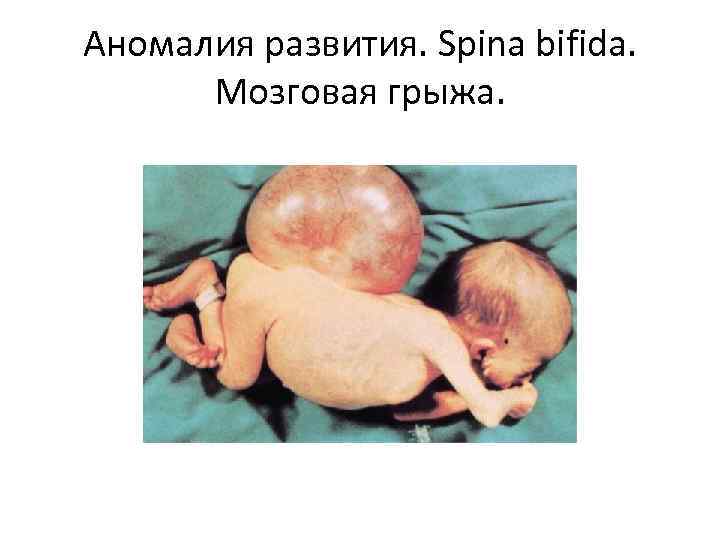 Аномалия развития. Spina bifida. Мозговая грыжа. 