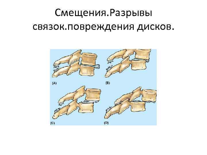 Смещения. Разрывы связок. повреждения дисков. 