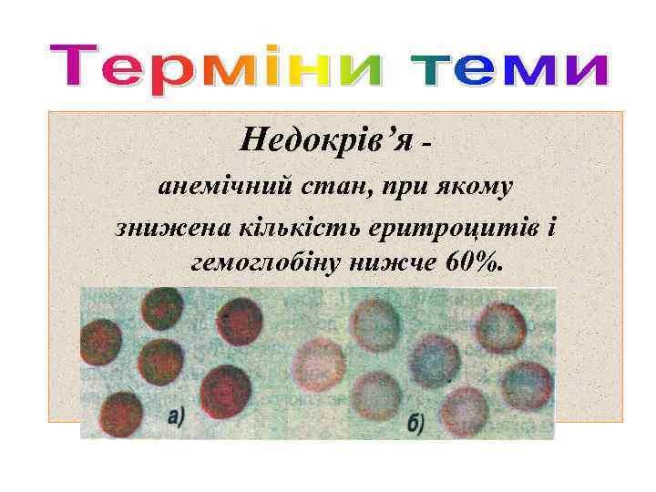 Недокрів’я анемічний стан, при якому знижена кількість еритроцитів і гемоглобіну нижче 60%. 