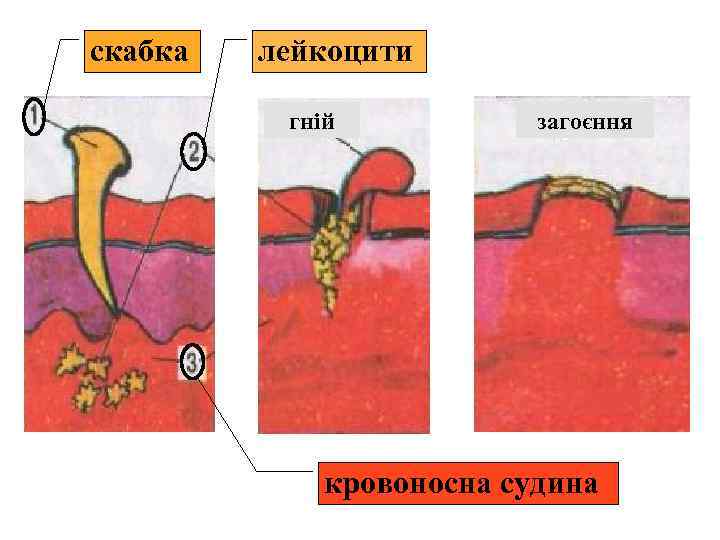 скабка лейкоцити гній загоєння кровоносна судина 