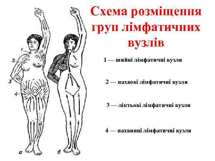 Схема розміщення груп лімфатичних вузлів 1 — шийні лімфатичні вузли 2 — пахвові лімфатичні