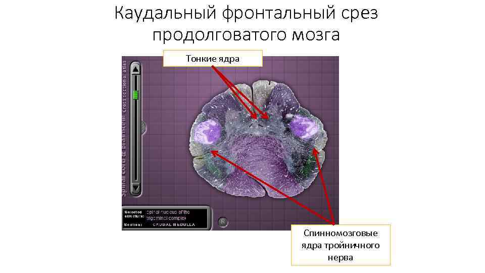 Каудальный фронтальный срез продолговатого мозга Тонкие ядра Спинномозговые ядра тройничного нерва 
