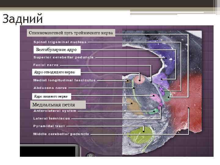Задний Спинномозговой путь тройничного нерва Вестибулярное ядро Ядро отводящего нерва Ядро лицевого нерва Медиальная