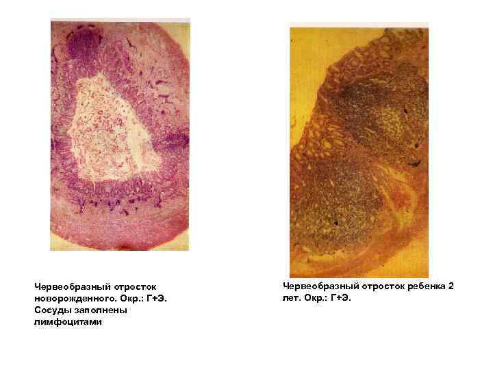 Червеобразный отросток новорожденного. Окр. : Г+Э. Сосуды заполнены лимфоцитами Червеобразный отросток ребенка 2 лет.
