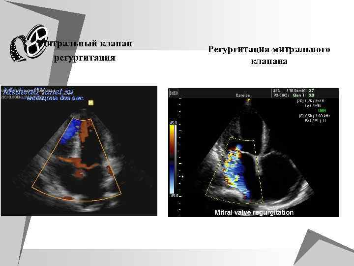 u Митральный клапан u регургитация Регургитация митрального клапана 