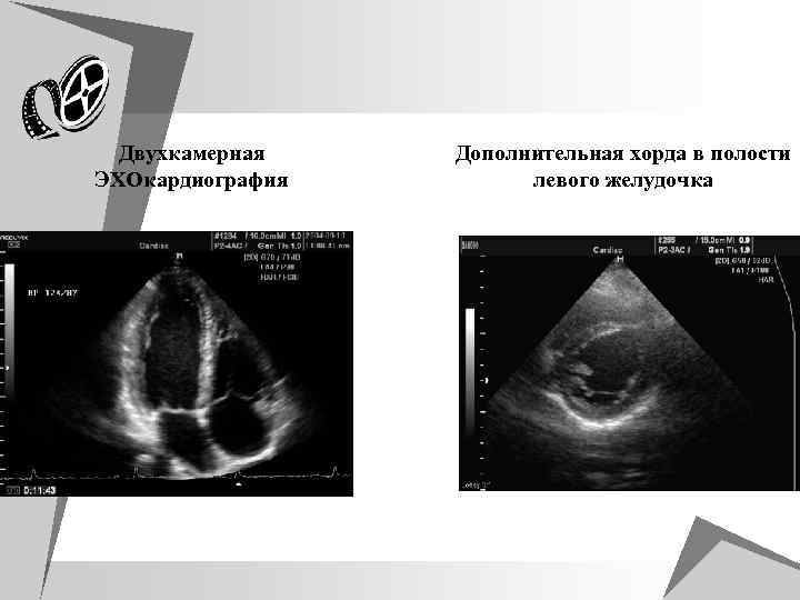 u Двухкамерная ЭХОкардиография Дополнительная хорда в полости левого желудочка 