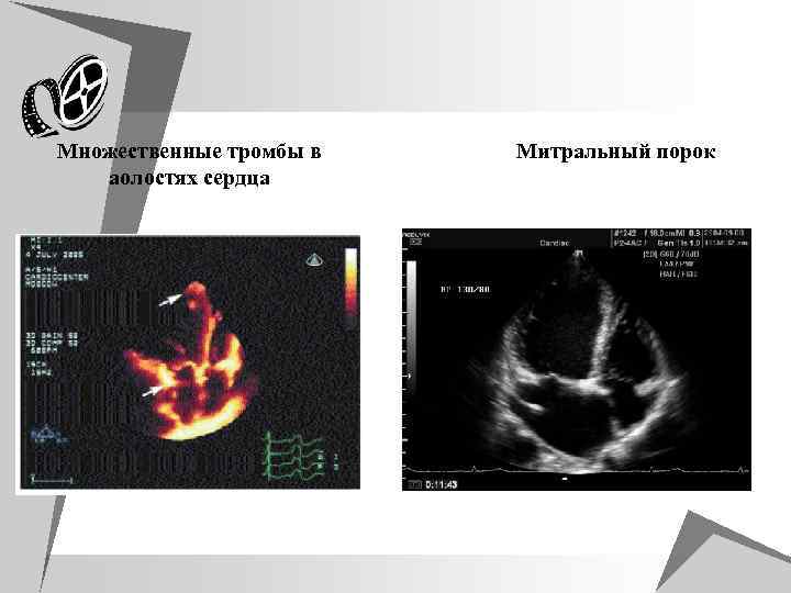 u Множественные тромбы в аолостях сердца Митральный порок 