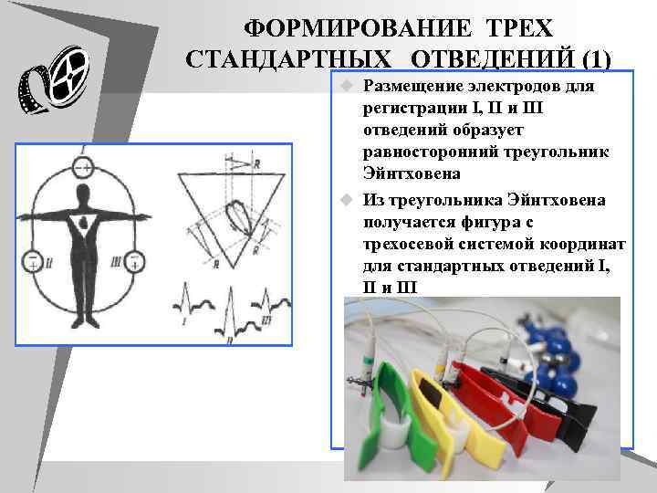 ФОРМИРОВАНИЕ ТРЕХ СТАНДАРТНЫХ ОТВЕДЕНИЙ (1) u Размещение электродов для регистрации I, II и III