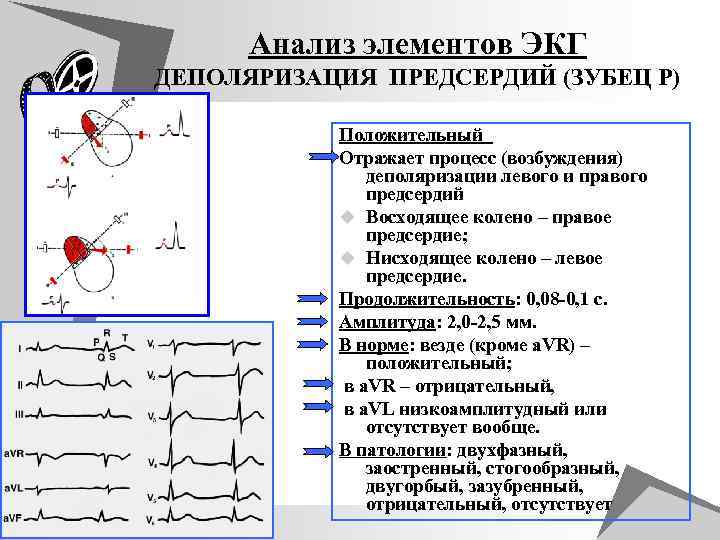 Анализ элементов ЭКГ ДЕПOЛЯРИЗАЦИЯ ПРЕДСЕРДИЙ (ЗУБЕЦ Р) Положительный Отражает процесс (возбуждения) деполяризации левого и