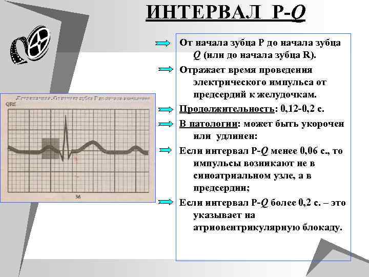 ИНТЕРВАЛ P-Q От начала зубца P до начала зубца Q (или до начала зубца