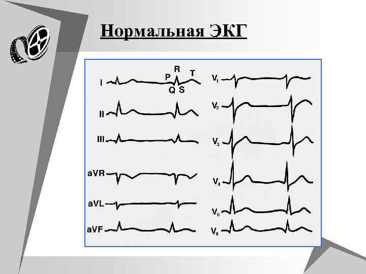 Нормальная ЭКГ 