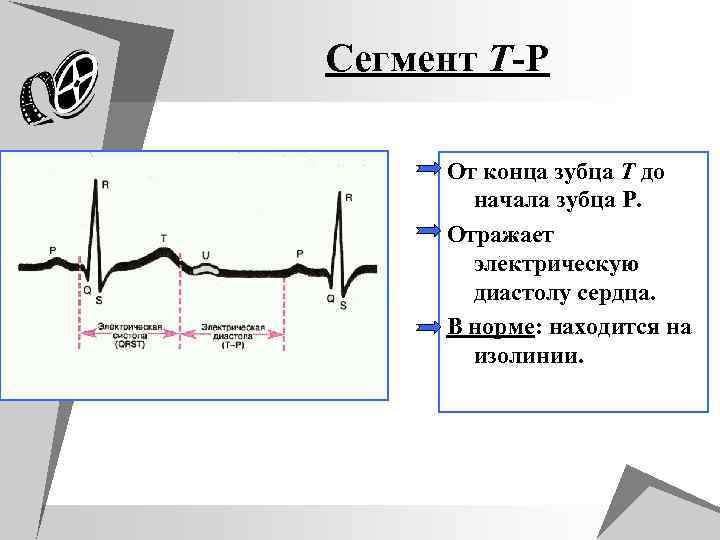 Сегмент T-P От конца зубца T до начала зубца P. Отражает электрическую диастолу сердца.