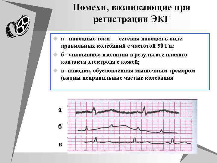 Помехи, возникающие при регистрации ЭКГ u а - наводные токи — сетевая наводка в