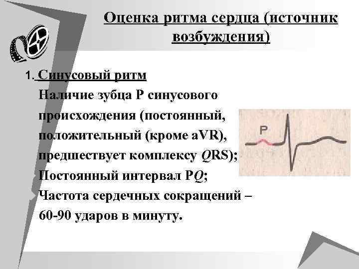 Оценка ритма сердца (источник возбуждения) 1. Синусовый ритм u Наличие зубца P синусового u