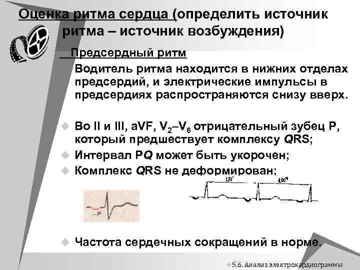 Оценка ритма сердца (определить источник ритма – источник возбуждения) Предсердный ритм Водитель ритма находится