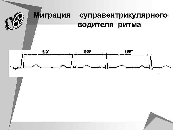 Миграция суправентрикулярного водителя ритма 