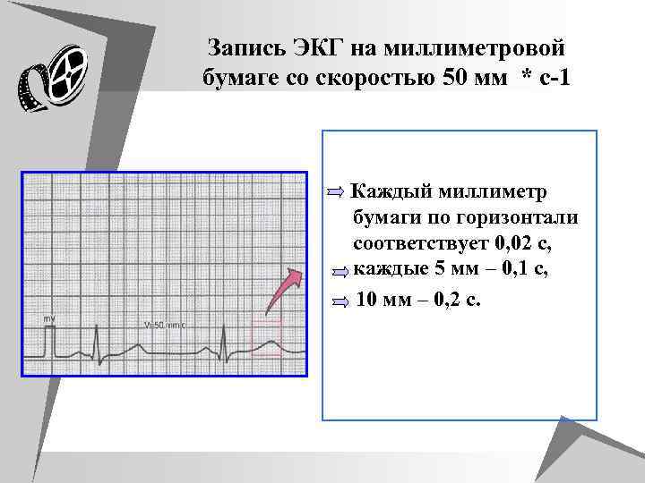 Запись ЭКГ на миллиметровой бумаге со скоростью 50 мм * с-1 Каждый миллиметр бумаги