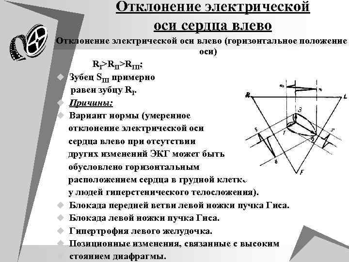 Отклонение эос влево. Горизонтальное отклонение оси на ЭКГ. Горизонтальное положение ЭОС на ЭКГ. Горизонтальная ось сердца на ЭКГ причины. Отклонение ЭОС горизонтальное.