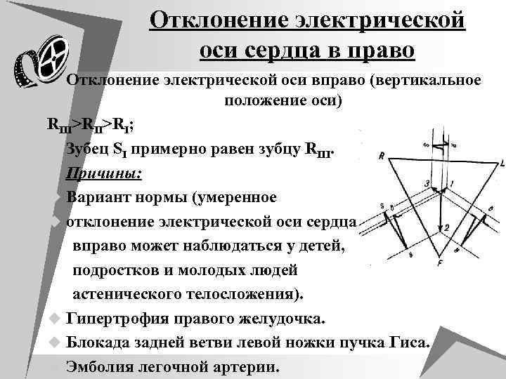 Горизонтальное положение оси. Отклонение электрической оси. Отклонение оси сердца. Электрическая ось сердца отклонена. Отклонение электрической оси сердца вправо.