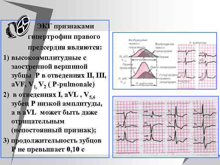 u ЭКГ признаками u гипертрофии правого u предсердия являются: 1) высокоамплитудные с заостренной вершиной