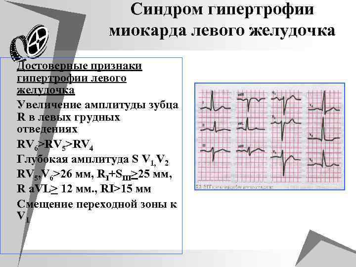 Синдром гипертрофии миокарда левого желудочка u Достоверные признаки гипертрофии левого желудочка u Увеличение амплитуды