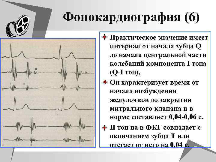 Фонокардиография (6) u Практическое значение имеет интервал от начала зубца Q до начала центральной