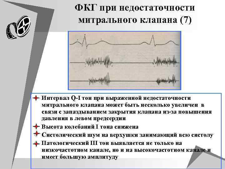 ФКГ при недостаточности митрального клапана (7) u Интервал Q-I тон при выраженной недостаточности митрального