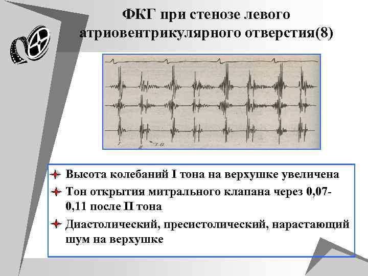 ФКГ при стенозе левого атриовентрикулярного отверстия(8) u Высота колебаний I тона на верхушке увеличена