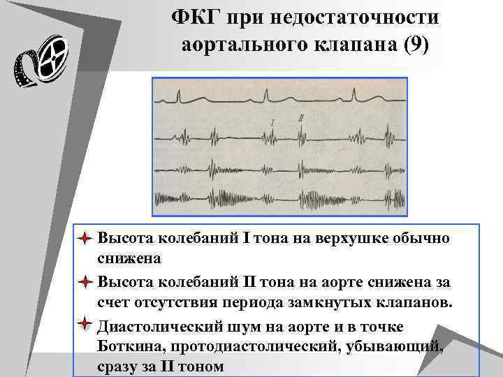 Аускультативная картина аортального стеноза