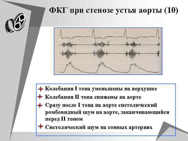 ФКГ при стенозе устья аорты (10) u Колебания I тона уменьшены на верхушке u