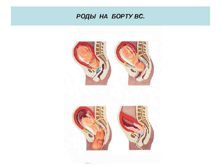 РОДЫ НА БОРТУ ВС. 