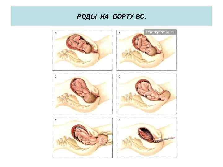 РОДЫ НА БОРТУ ВС. 
