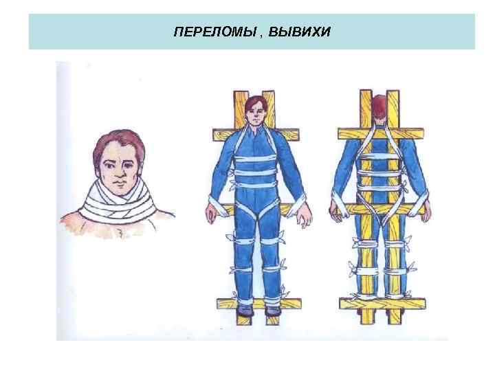 ПЕРЕЛОМЫ , ВЫВИХИ 