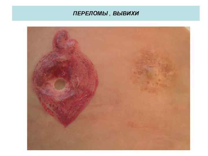 ПЕРЕЛОМЫ , ВЫВИХИ 