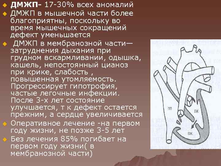 u u u ДМЖП- 17 -30% всех аномалий ДМЖП в мышечной части более благоприятны,