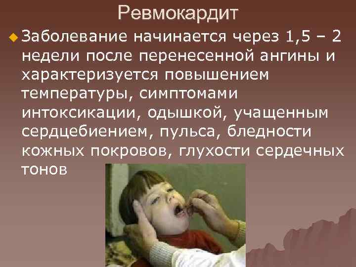 Ревмокардит u Заболевание начинается через 1, 5 – 2 недели после перенесенной ангины и