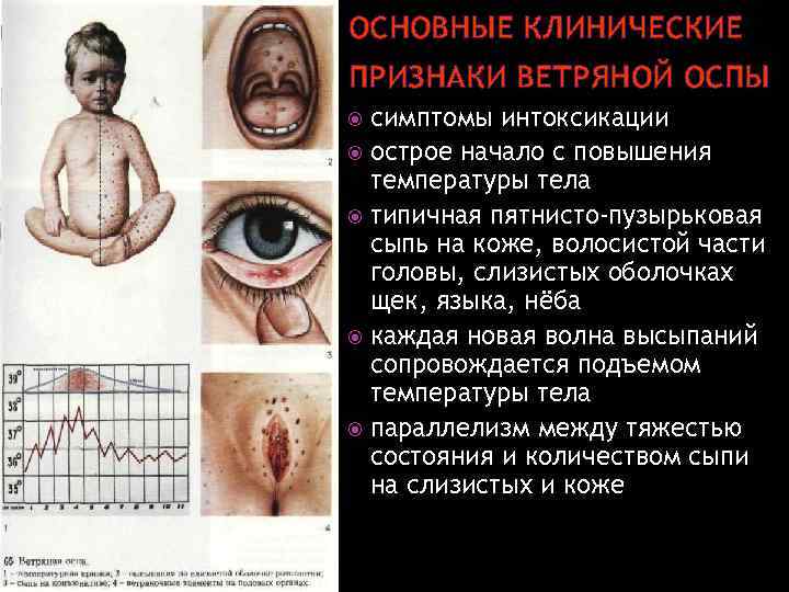 ОСНОВНЫЕ КЛИНИЧЕСКИЕ ПРИЗНАКИ ВЕТРЯНОЙ ОСПЫ симптомы интоксикации острое начало с повышения температуры тела типичная