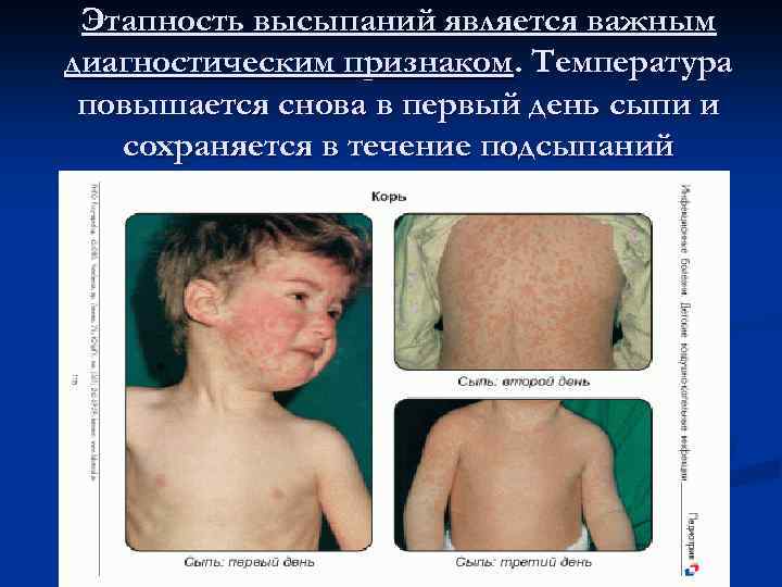 Этапность высыпаний является важным диагностическим признаком. Температура повышается снова в первый день сыпи и