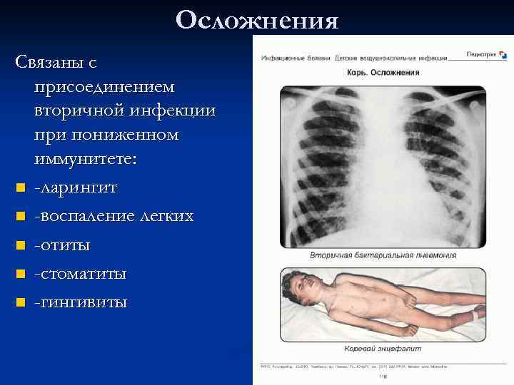 Осложнения Связаны с присоединением вторичной инфекции при пониженном иммунитете: n -ларингит n -воспаление легких