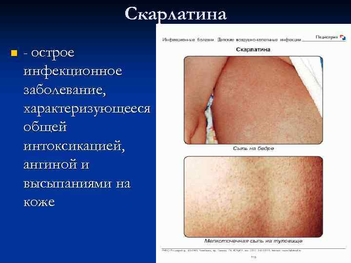 Скарлатина n - острое инфекционное заболевание, характеризующееся общей интоксикацией, ангиной и высыпаниями на коже