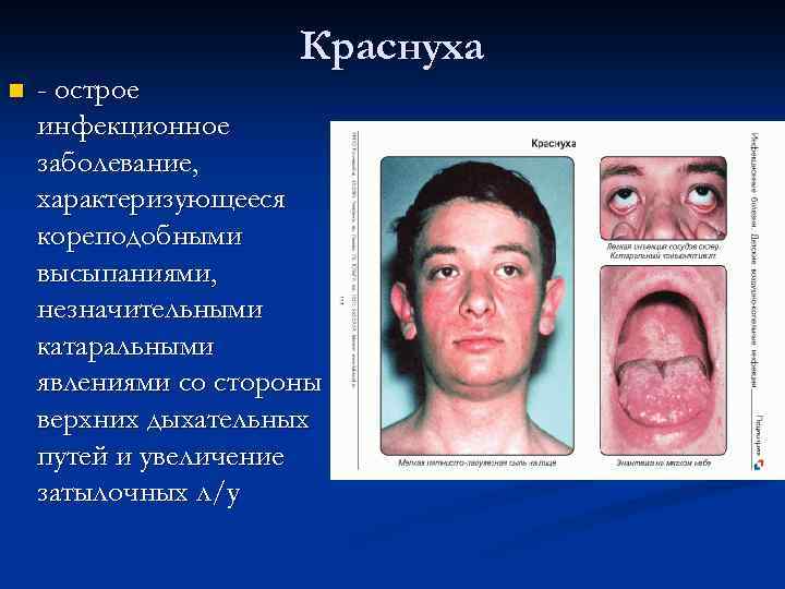 Краснуха n - острое инфекционное заболевание, характеризующееся кореподобными высыпаниями, незначительными катаральными явлениями со стороны
