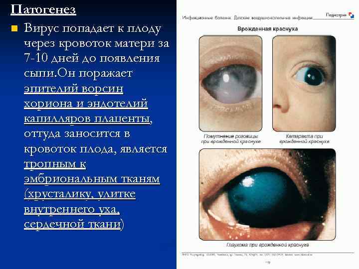 Патогенез n Вирус попадает к плоду через кровоток матери за 7 -10 дней до