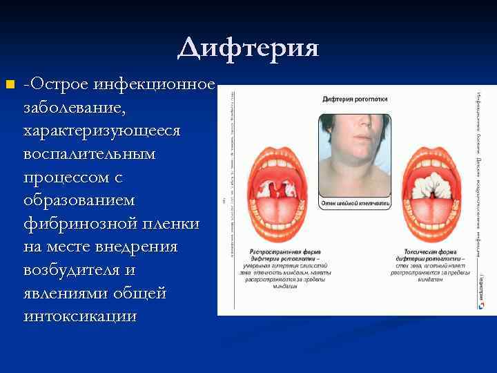 Дифтерия n -Острое инфекционное заболевание, характеризующееся воспалительным процессом с образованием фибринозной пленки на месте