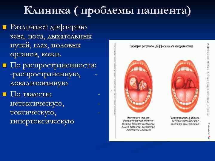 Дифтерия презентация казакша