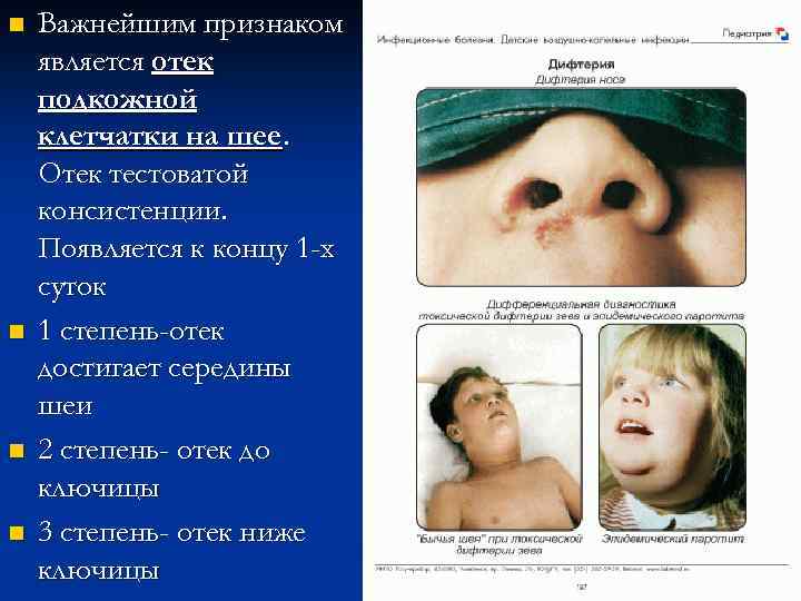n n Важнейшим признаком является отек подкожной клетчатки на шее. Отек тестоватой консистенции. Появляется