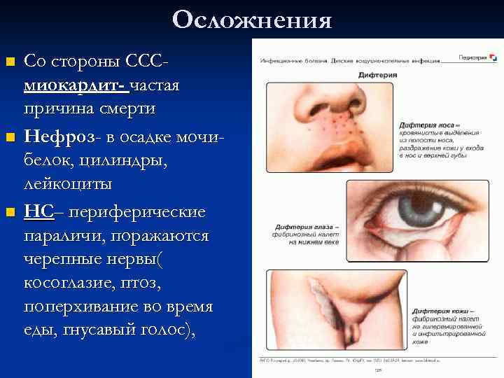 Осложнения n n n Со стороны СССмиокардит- частая причина смерти Нефроз- в осадке мочибелок,