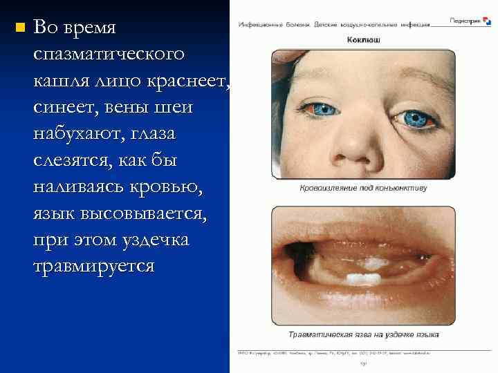 n Во время спазматического кашля лицо краснеет, синеет, вены шеи набухают, глаза слезятся, как