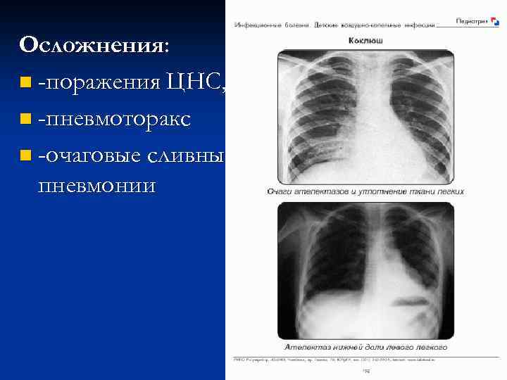 Очаговые поражения цнс. Очагово сливная пневмония. Очагово сливная пневмония у детей. Правосторонняя очагово сливная пневмония мкб. Очагово сливной спевнонии.